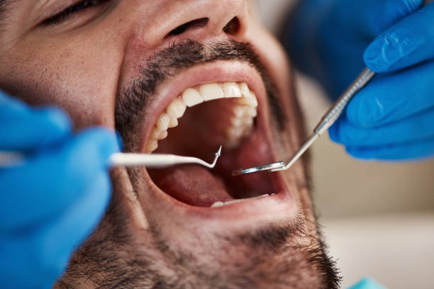 Teeth Whitening in SC
